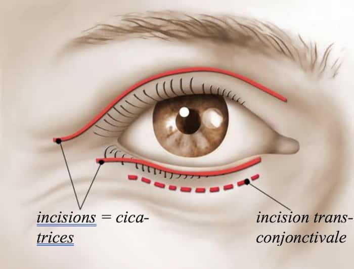 Blepharoplastie