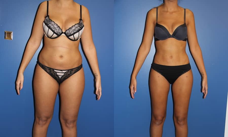 photos-chirurgie-esthetique-paris-corps-cuisses-genoux-1