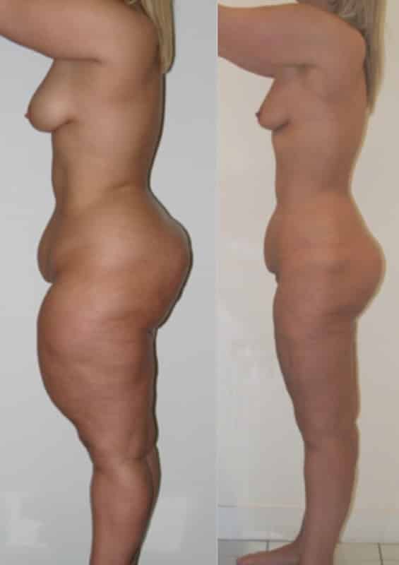 photos-chirurgie-esthetique-paris-corps-cuisses-genoux-10