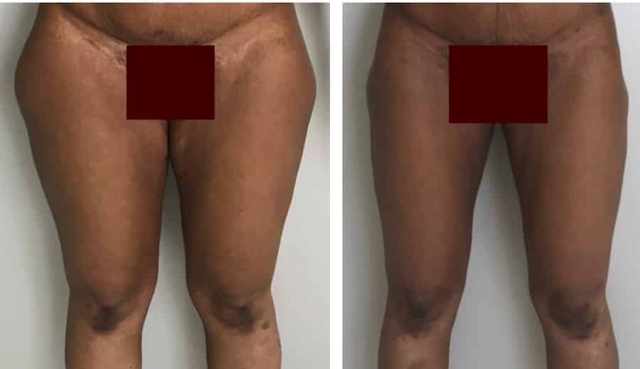 photos-chirurgie-esthetique-paris-corps-cuisses-genoux-11