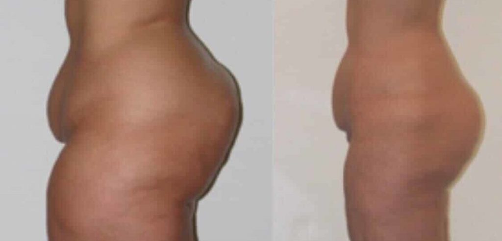 photos-chirurgie-esthetique-paris-corps-cuisses-genoux-2