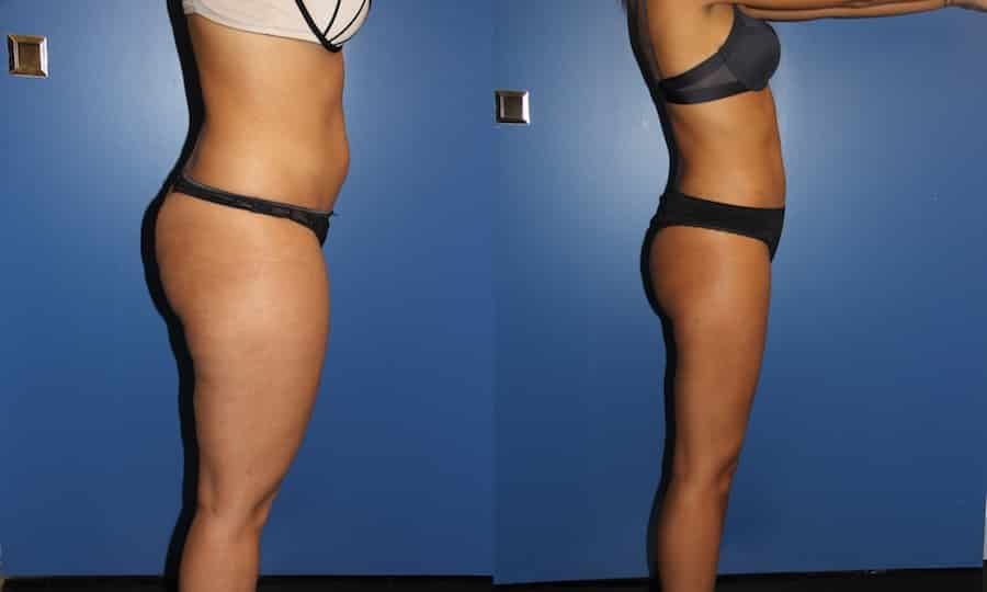 photos-chirurgie-esthetique-paris-corps-cuisses-genoux-4
