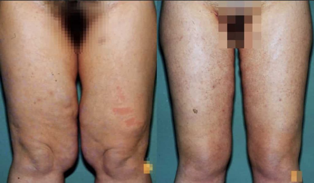 photos-chirurgie-esthetique-paris-corps-cuisses-genoux-5
