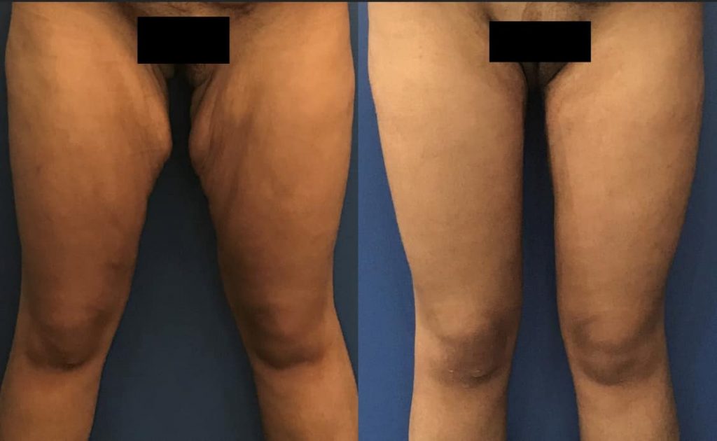 photos-chirurgie-esthetique-paris-corps-cuisses-genoux-8