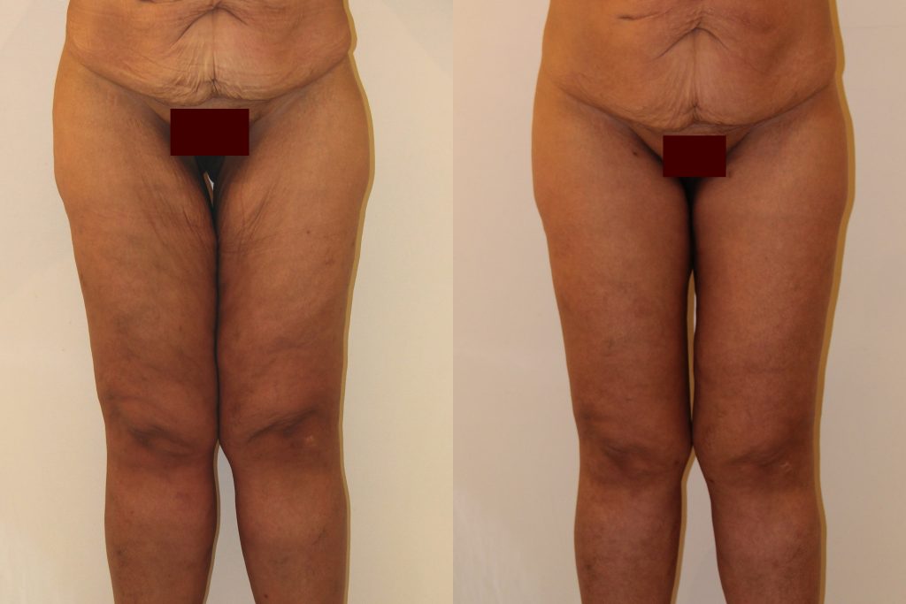 photos-chirurgie-esthetique-paris-corps-cuisses-genoux-9