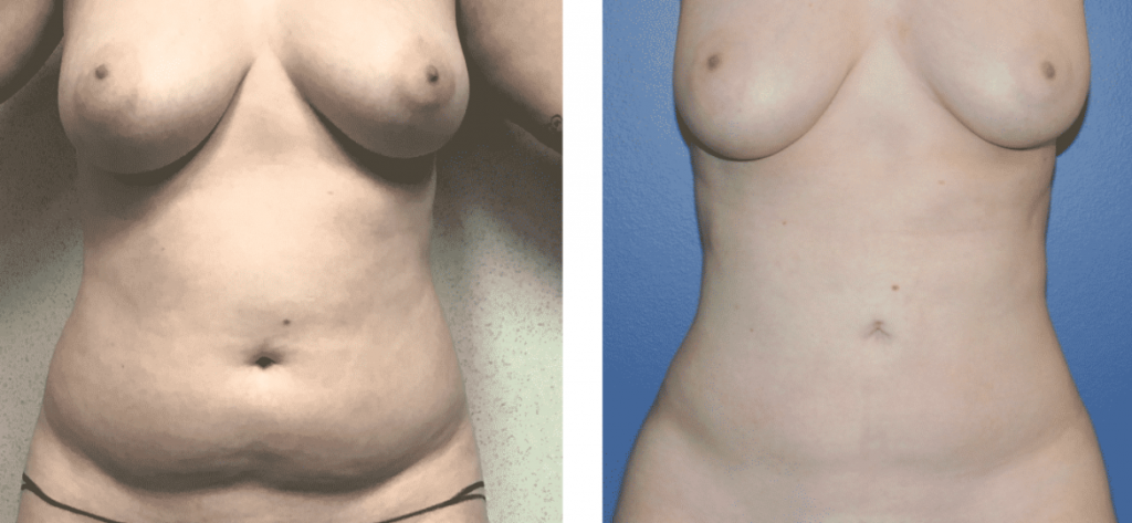 photos-chirurgie-esthetique-paris-corps-liposuccion-1
