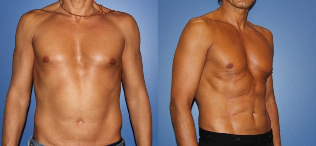 photos-chirurgie-esthetique-paris-corps-liposuccion-10
