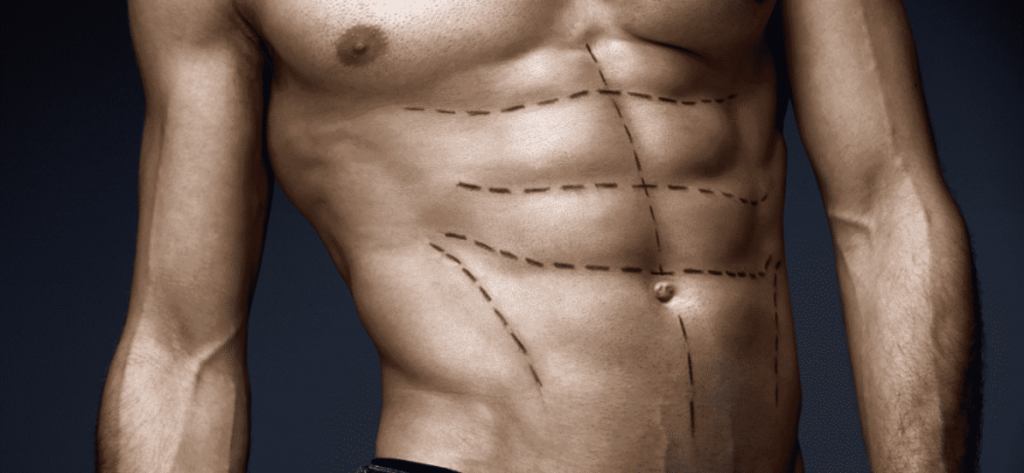 photos-chirurgie-esthetique-paris-corps-liposuccion-11