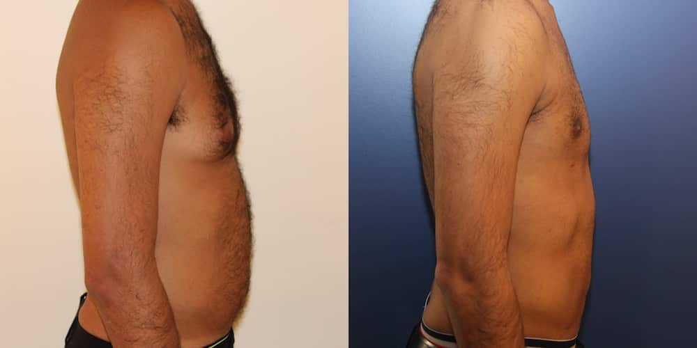 photos-chirurgie-esthetique-paris-corps-liposuccion-12