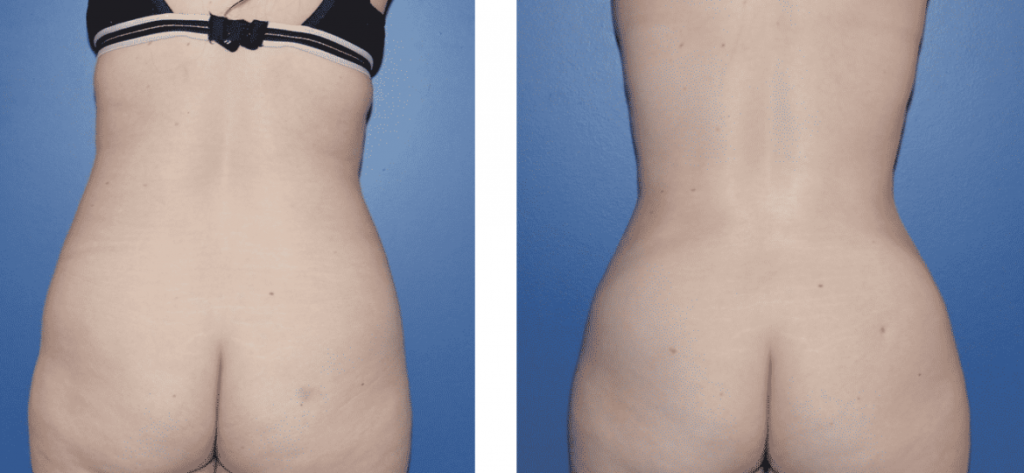 photos-chirurgie-esthetique-paris-corps-liposuccion-2