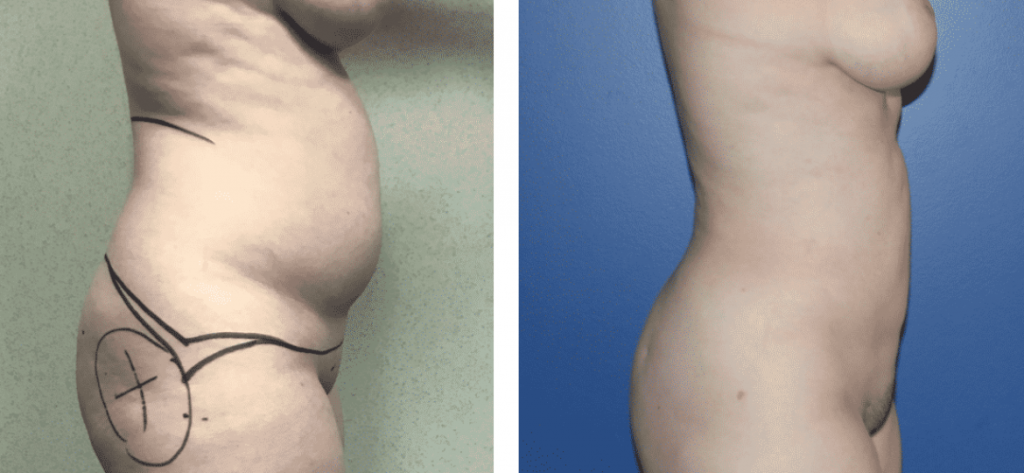 photos-chirurgie-esthetique-paris-corps-liposuccion-3