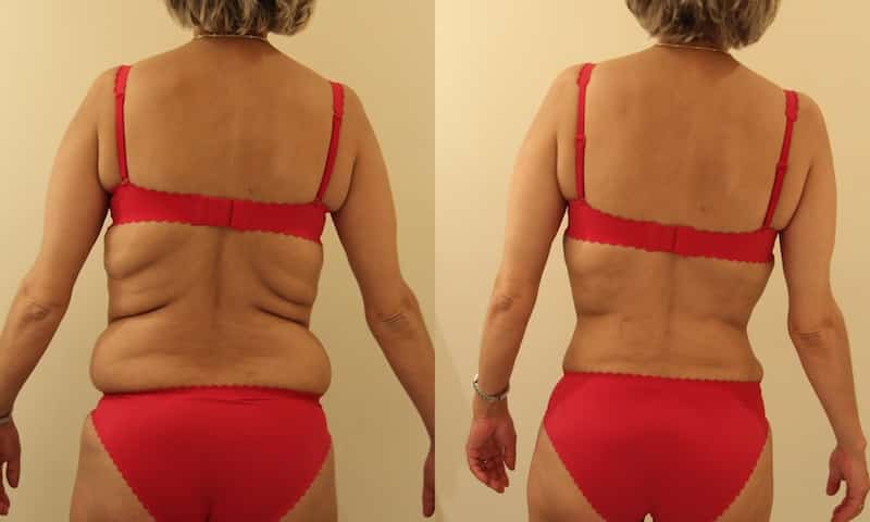 photos-chirurgie-esthetique-paris-corps-liposuccion-4