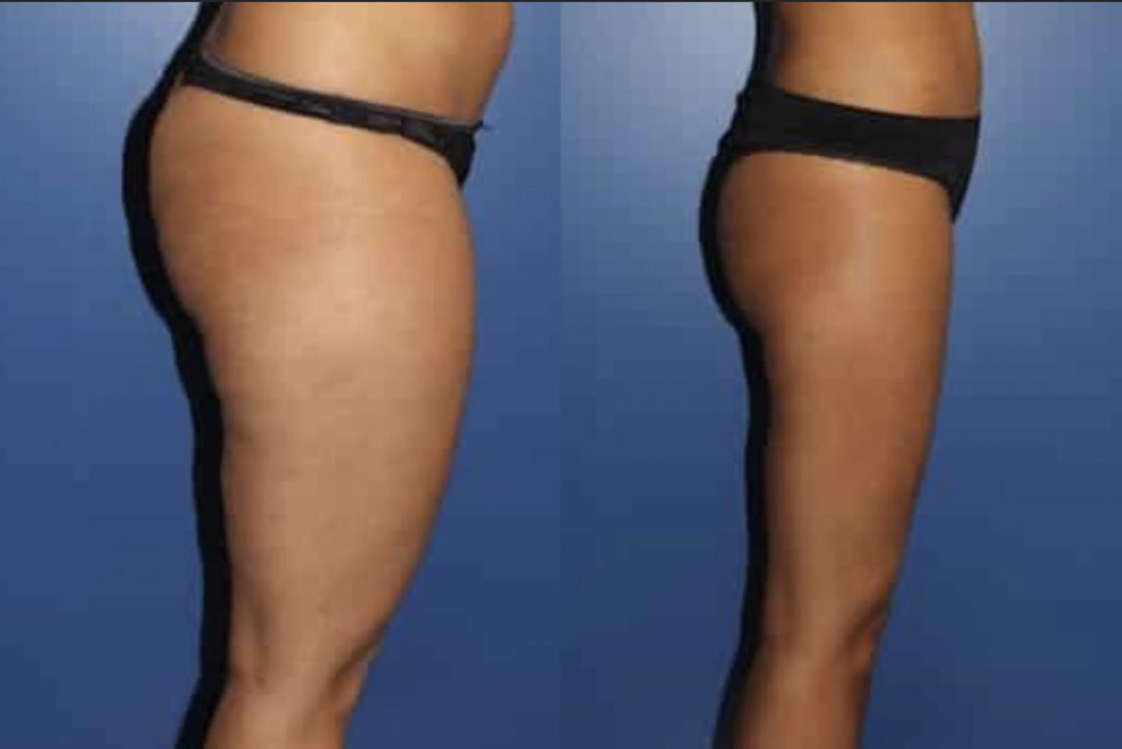 photos-chirurgie-esthetique-paris-corps-liposuccion-5