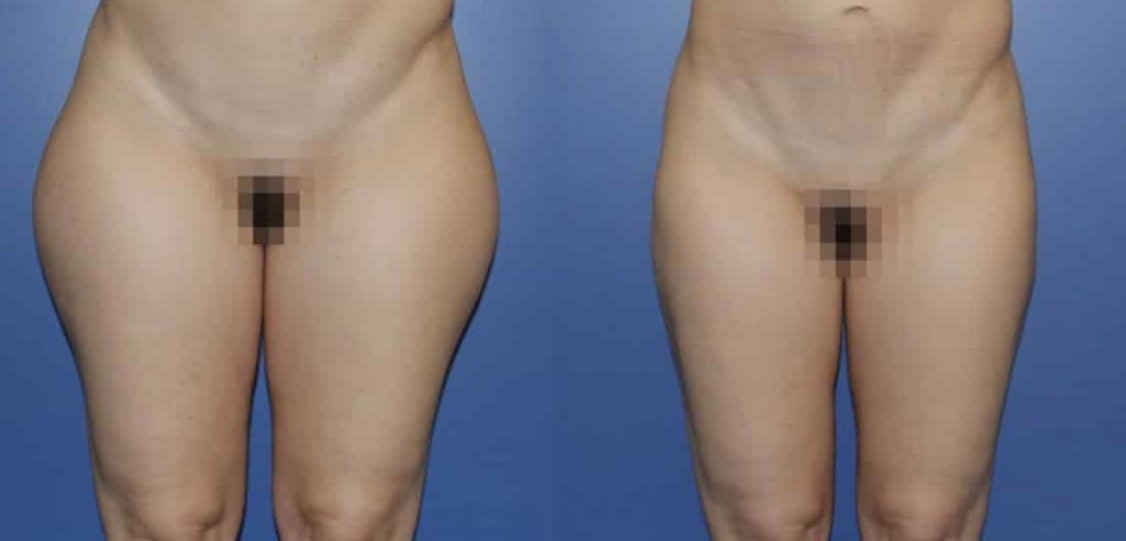photos-chirurgie-esthetique-paris-corps-liposuccion-6