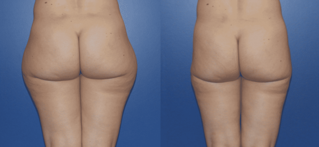 photos-chirurgie-esthetique-paris-corps-liposuccion-7