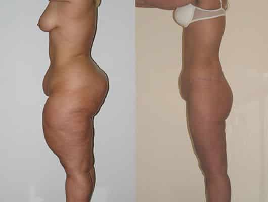 photos-chirurgie-esthetique-paris-corps-liposuccion-8