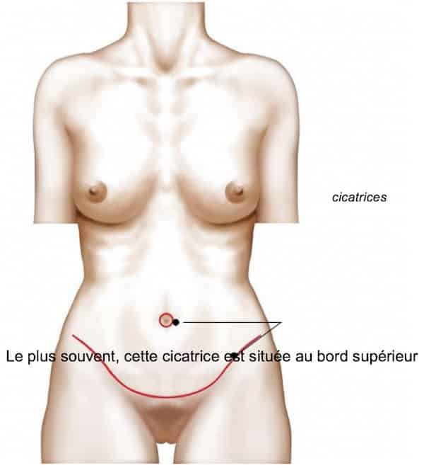 photos chirurgie esthetique du corps à paris (ventre)