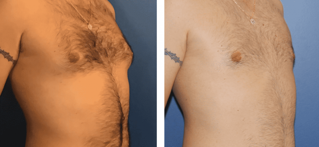 photos-chirurgie-esthetique-paris-hommes-gynecomastie-1