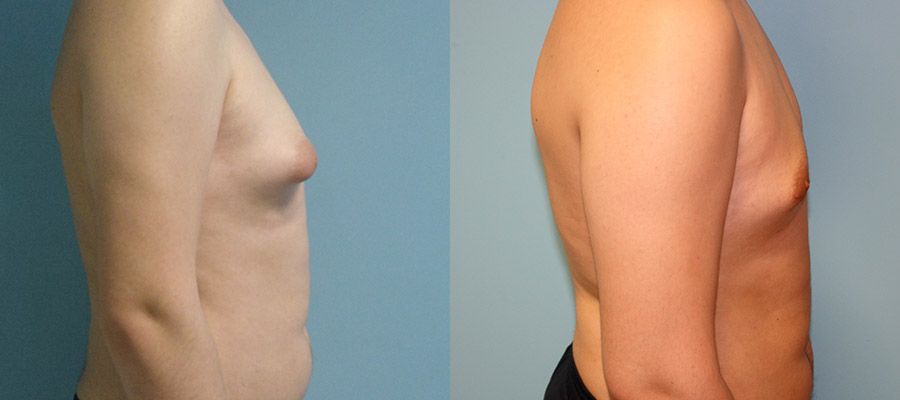photos-chirurgie-esthetique-paris-hommes-gynecomastie-2