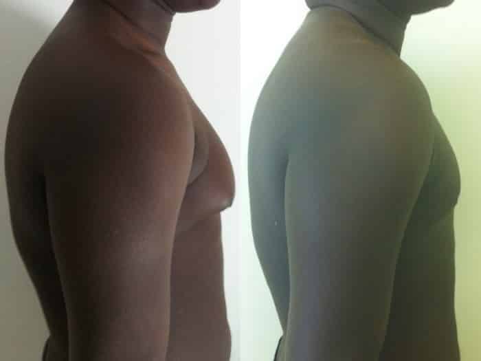 photos-chirurgie-esthetique-paris-hommes-gynecomastie-3