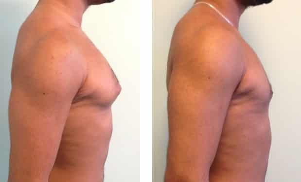 photos-chirurgie-esthetique-paris-hommes-gynecomastie-4