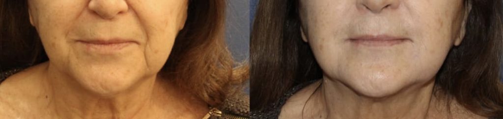 photos-chirurgie-esthetique-paris-medecine-esthetique-acide-hyaluronique-1