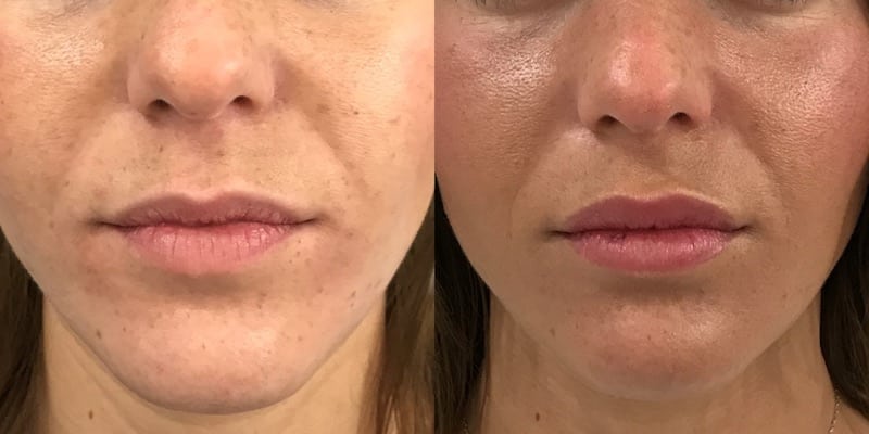 photos-chirurgie-esthetique-paris-medecine-esthetique-acide-hyaluronique-11