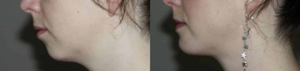 photos-chirurgie-esthetique-paris-medecine-esthetique-acide-hyaluronique-13