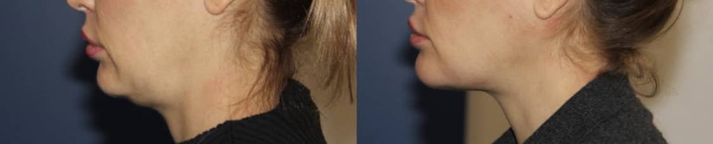 photos-chirurgie-esthetique-paris-medecine-esthetique-acide-hyaluronique-14