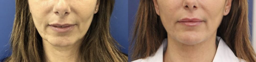photos-chirurgie-esthetique-paris-medecine-esthetique-acide-hyaluronique-15