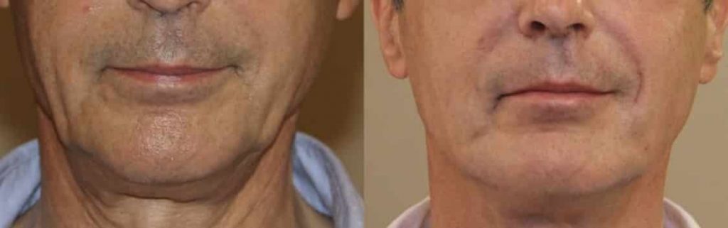photos-chirurgie-esthetique-paris-medecine-esthetique-acide-hyaluronique-16