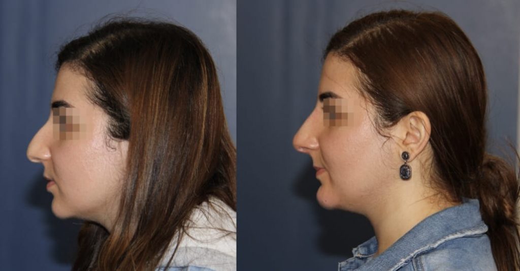photos-chirurgie-esthetique-paris-medecine-esthetique-acide-hyaluronique-17
