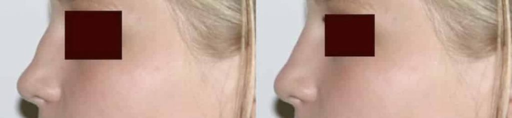 photos-chirurgie-esthetique-paris-medecine-esthetique-acide-hyaluronique-18