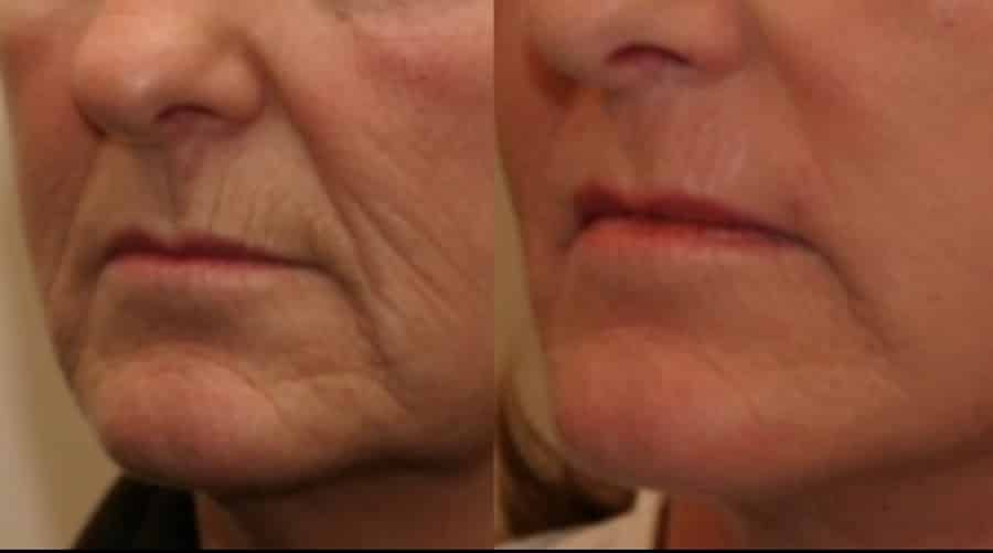 photos-chirurgie-esthetique-paris-medecine-esthetique-acide-hyaluronique-2