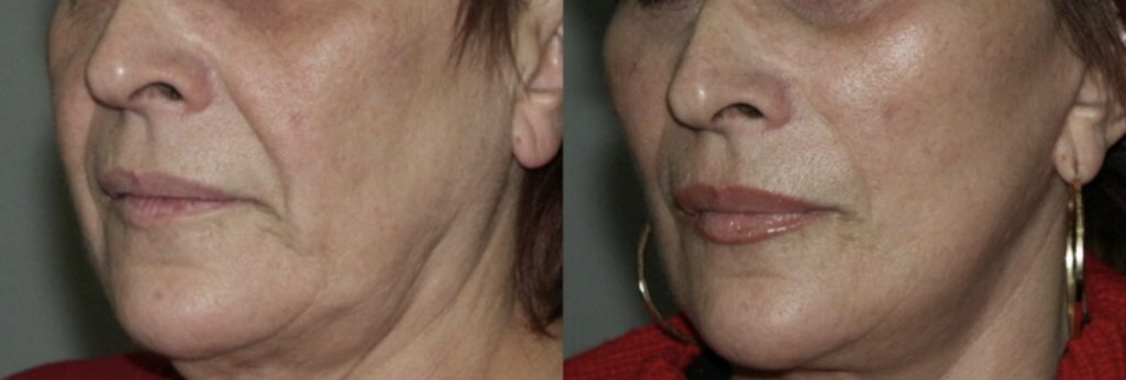 photos-chirurgie-esthetique-paris-medecine-esthetique-acide-hyaluronique-3