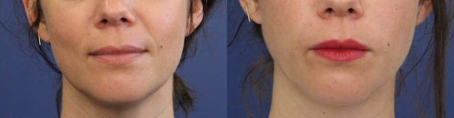 photos-chirurgie-esthetique-paris-medecine-esthetique-acide-hyaluronique-4