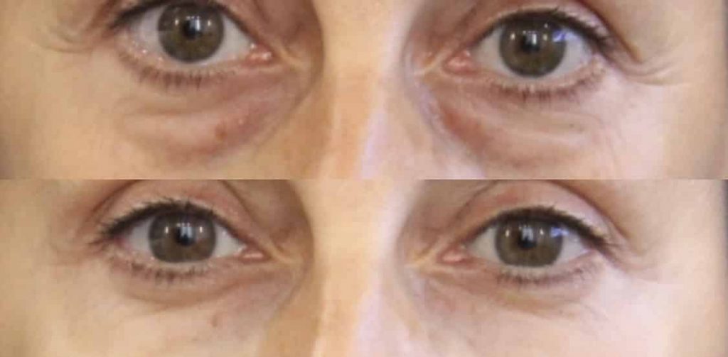 photos-chirurgie-esthetique-paris-medecine-esthetique-acide-hyaluronique-6