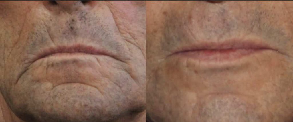 photos-chirurgie-esthetique-paris-medecine-esthetique-acide-hyaluronique-7
