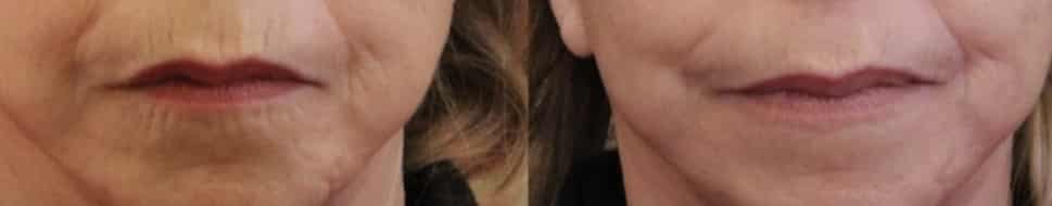 photos-chirurgie-esthetique-paris-medecine-esthetique-acide-hyaluronique-8