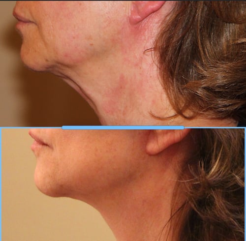 photos-chirurgie-esthetique-paris-medecine-esthetique-botox-10