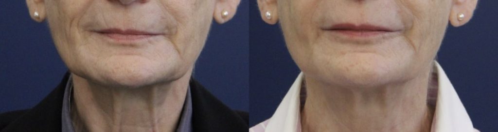 photos-chirurgie-esthetique-paris-medecine-esthetique-botox-11