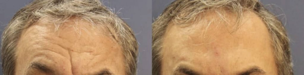 photos-chirurgie-esthetique-paris-medecine-esthetique-botox-13