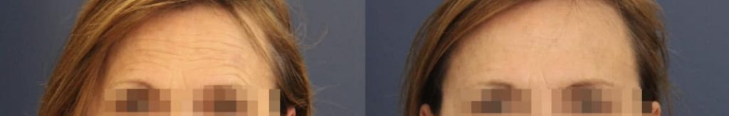 photos-chirurgie-esthetique-paris-medecine-esthetique-botox-14