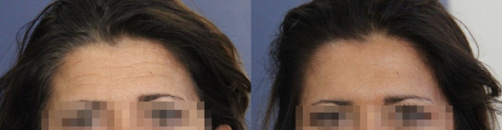 photos-chirurgie-esthetique-paris-medecine-esthetique-botox-15