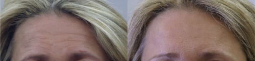 photos-chirurgie-esthetique-paris-medecine-esthetique-botox-16