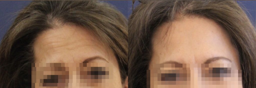photos-chirurgie-esthetique-paris-medecine-esthetique-botox-2