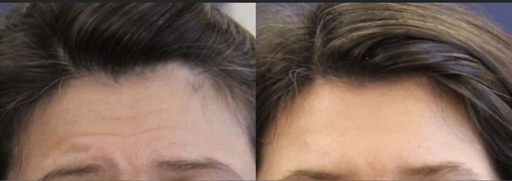 photos-chirurgie-esthetique-paris-medecine-esthetique-botox-4