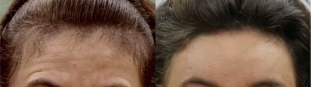 photos-chirurgie-esthetique-paris-medecine-esthetique-botox-5