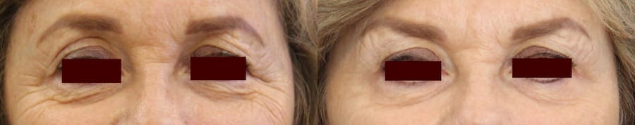 photos-chirurgie-esthetique-paris-medecine-esthetique-botox-6