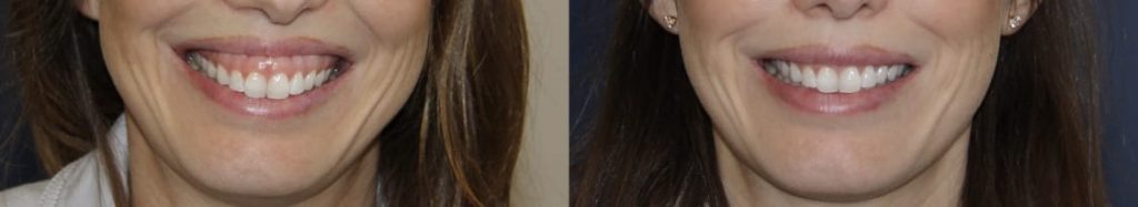 photos-chirurgie-esthetique-paris-medecine-esthetique-botox-8